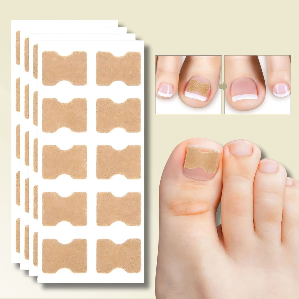 Patches pour Ongles Incarnés et Mycose - Soulagement Instantané et Croissance Saine