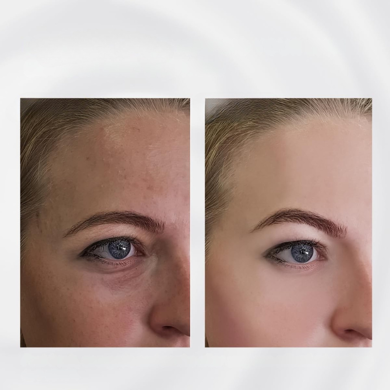 Rouleau pour les Yeux en Acier Inoxydable - Réduit Cernes et Poches Sous les Yeux