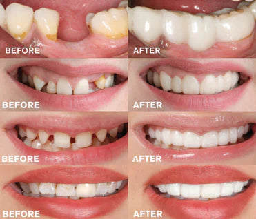 Prothèse Dentaire Facile à Utiliser - Sourire Naturel Instantané et Réutilisable